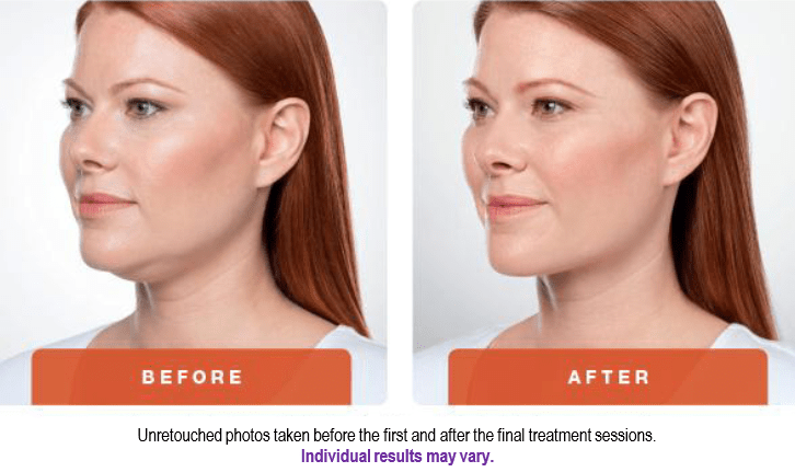 kybella-double-chin-before-and-after