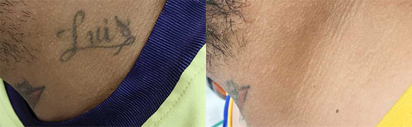 tattoo-removal-before-and-after