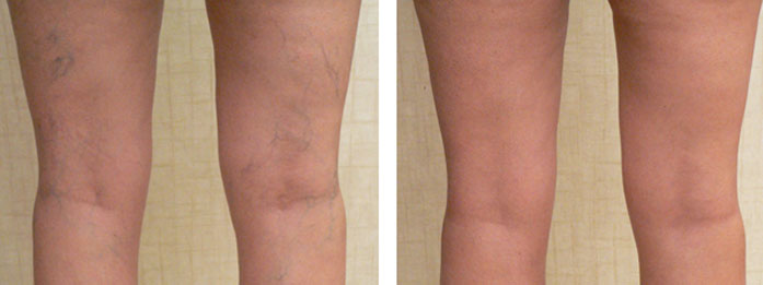 spider-vein-removal-results-before-and-after