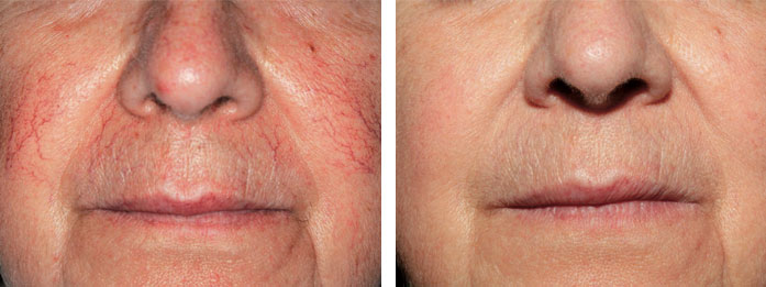 spider-vein-removal-results-before-and-after
