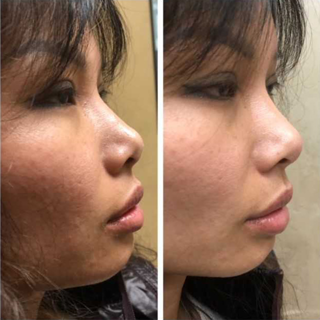 voluma-lips-before-and-after