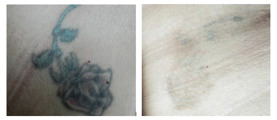 tattoo-removal-before-and-after